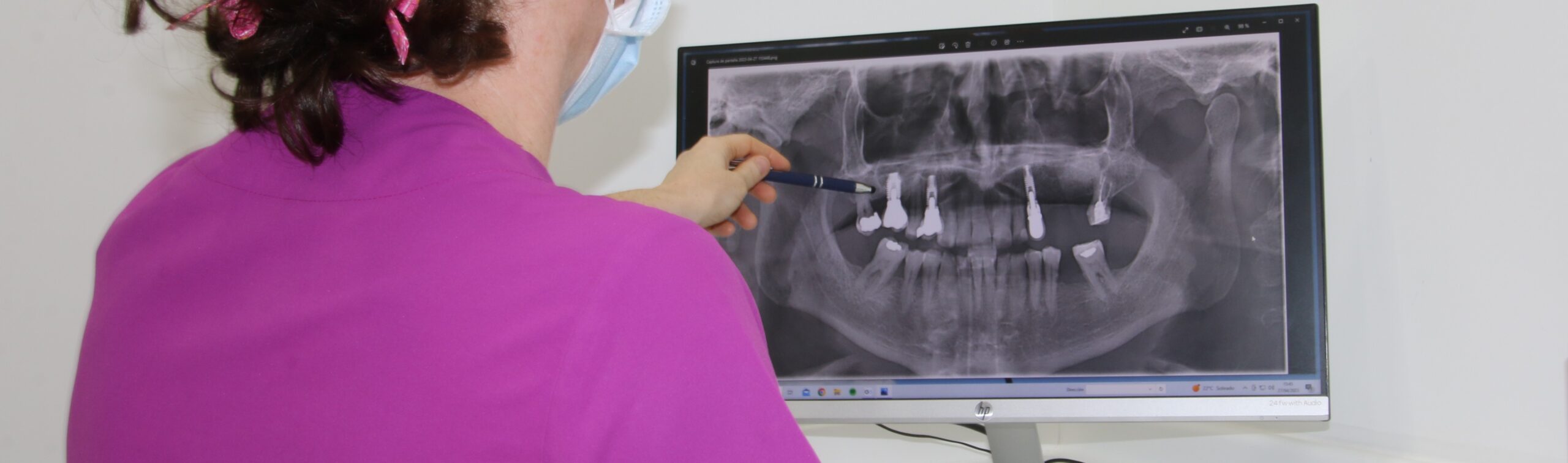 Implantes Irriak Hortz Klinika Clínica Dental